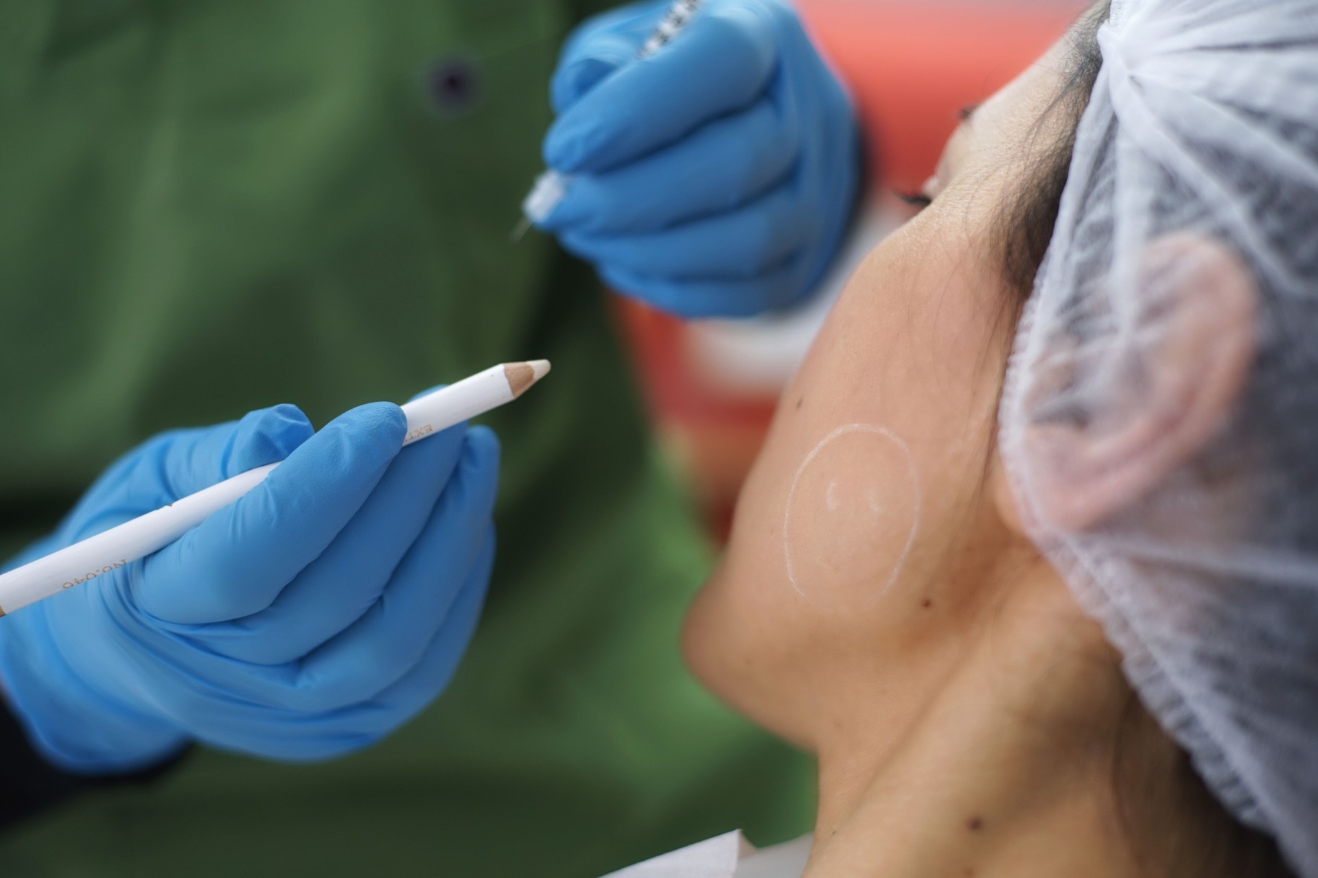 Dermal Fillers, Botox, Medical Substance injection for Face Treatment